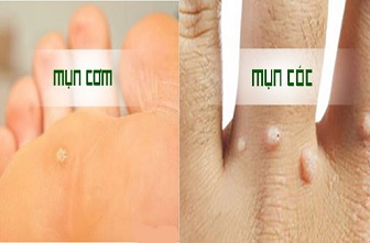 Mụn cóc và mụn cơm có khác nhau không?