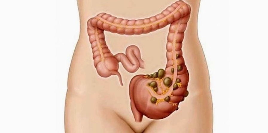 Cơn đau vùng bụng trái có thể là triệu chứng của bệnh viêm túi thừa ở đại tràng