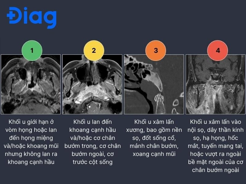 Hình ảnh chụp MRI và CT cho thấy sự tiến triển của khối u ung thư vòm họng qua các giai đoạn