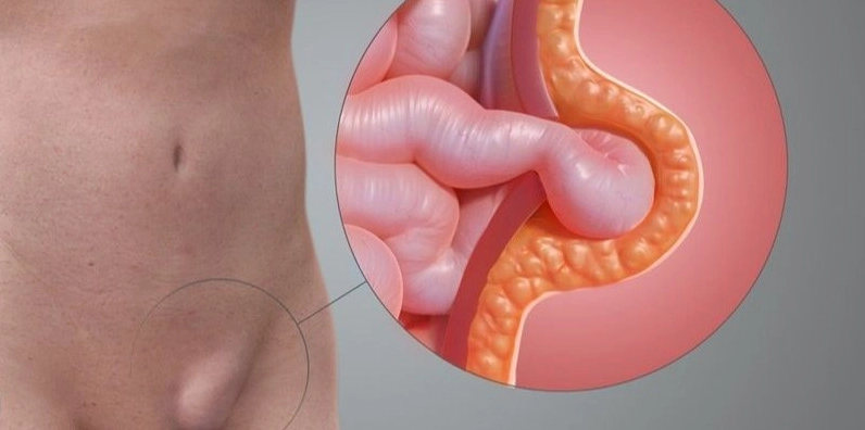 Hình ảnh minh họa tình trạng thoát vị bẹn có thể gây ra cơn đau bụng bên trái