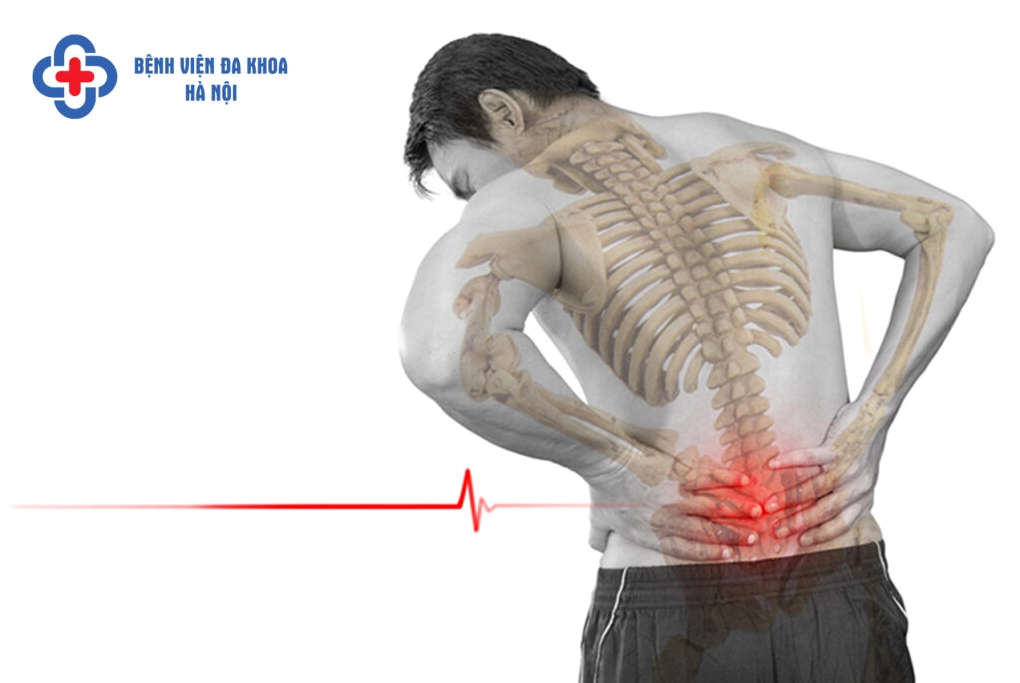 Hình ảnh minh họa tình trạng thoát vị đĩa đệm chèn ép rễ thần kinh