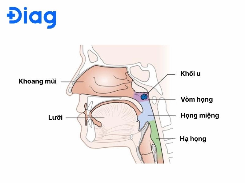 Hình ảnh mô phỏng cấu trúc vòm họng và vị trí xuất hiện khối u ung thư giai đoạn đầu