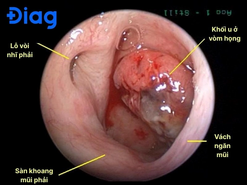 Hình ảnh nội soi vòm họng cho thấy một khối u bất thường đang phát triển ở giai đoạn đầu