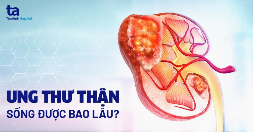Bác sĩ giải thích cho bệnh nhân về tiên lượng sống của ung thư thận