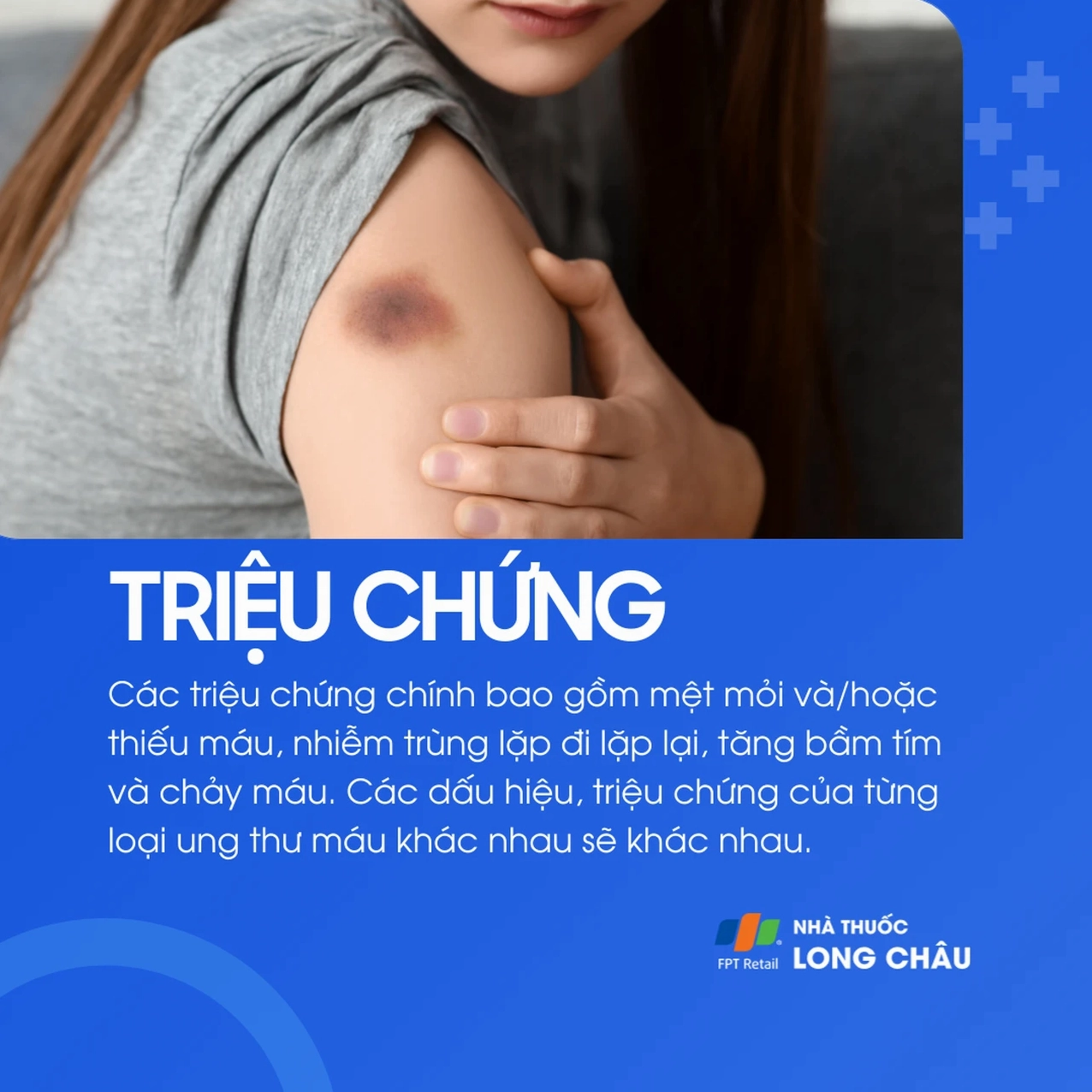 Các vết bầm tím xuất hiện không rõ lý do trên da cảnh báo bệnh ung thư máu.