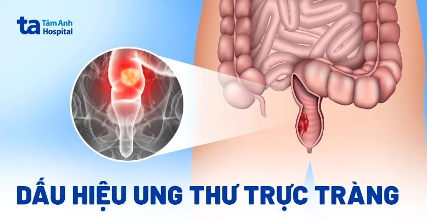 Đồ họa liệt kê các dấu hiệu ung thư trực tràng dễ nhận biết mà mọi người không nên bỏ qua.