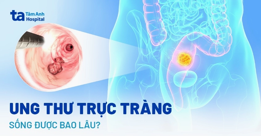 Đồ họa thông tin giải thích về tiên lượng sống của bệnh nhân ung thư trực tràng qua từng giai đoạn cụ thể.