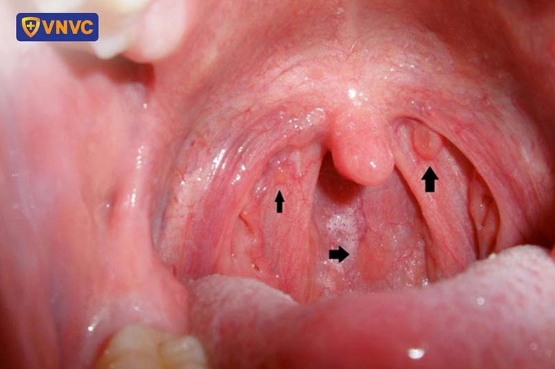Hình ảnh khối u ung thư vòm họng trong giai đoạn đầu khi quan sát qua nội soi