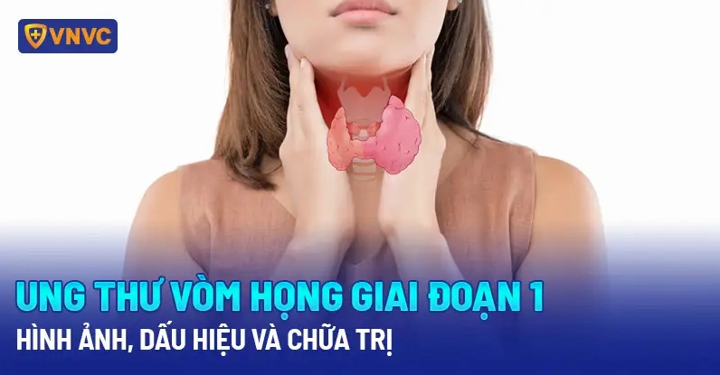 Hình ảnh minh họa ung thư vòm họng giai đoạn 1 với khối u còn khu trú