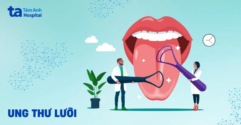 Hình ảnh mô phỏng vị trí khối u ác tính trong bệnh ung thư lưỡi