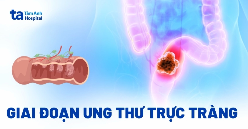 Mô hình minh họa các giai đoạn ung thư trực tràng từ giai đoạn 0 đến giai đoạn IV.