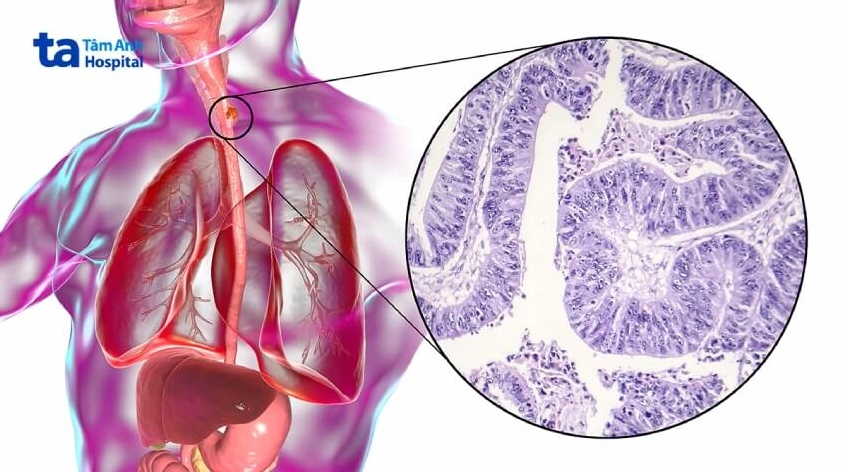 Mô phỏng khối u ung thư thực quản ở giai đoạn đầu