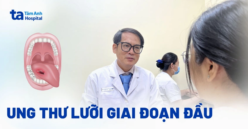 Một vết loét nhỏ không lành có thể là dấu hiệu sớm của ung thư lưỡi giai đoạn đầu