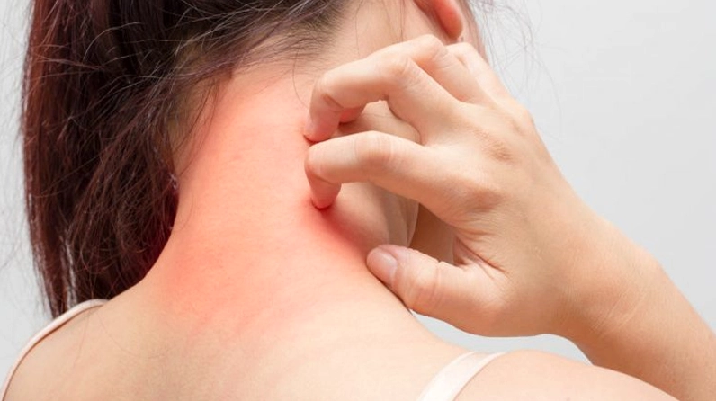 Rau kinh giới có tác dụng hỗ trợ trị dị ứng