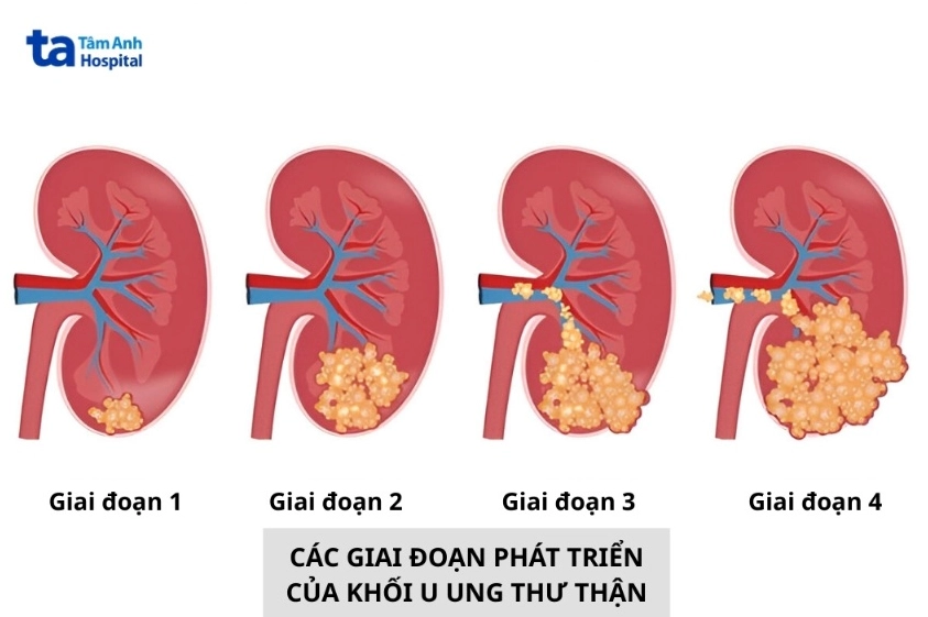 Sơ đồ minh họa 4 giai đoạn phát triển của khối u ung thư thận