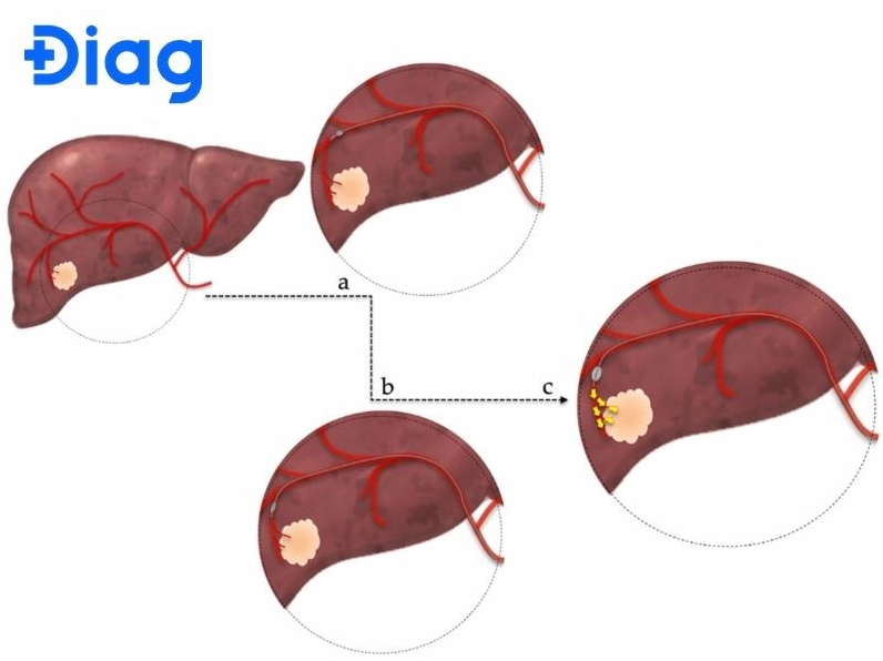 Sơ đồ mô tả kỹ thuật TACE hay nút mạch hóa chất trong điều trị ung thư gan