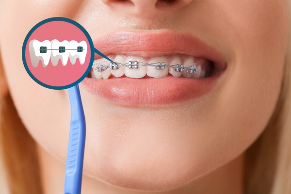 Nha khoa Nhổn uy tín – Chăm sóc răng miệng tại Xanh Dental