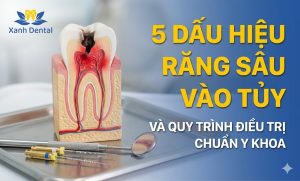 Bạn đang tìm địa chỉ chữa đau răng Nhổn uy tín? Khám phá Nha Khoa Xanh Dental CS2 (93 Phố Nhổn) - điều trị dứt điểm sâu răng, viêm tủy không đau, giá tốt.